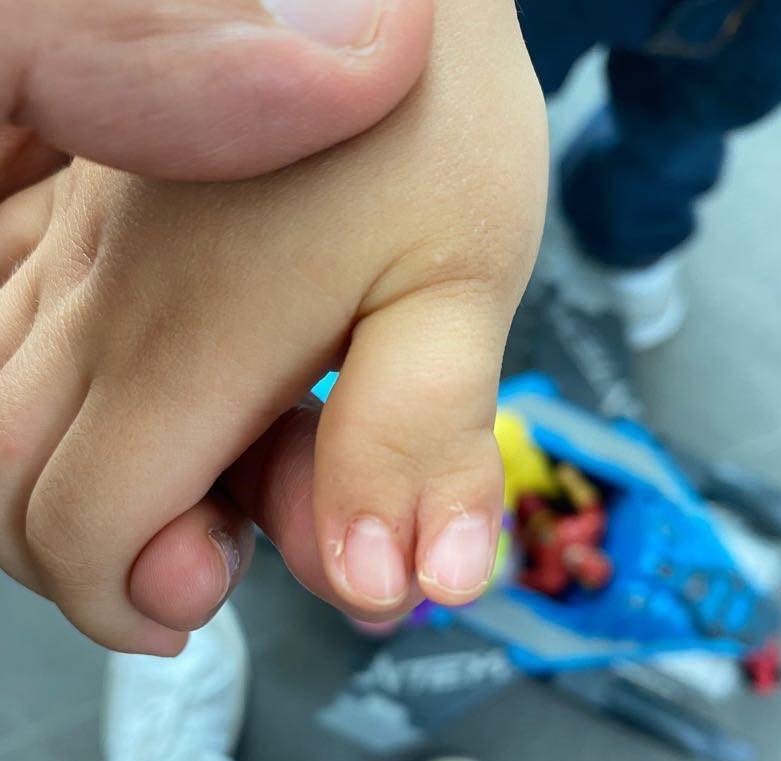 recostruccion de pulgar