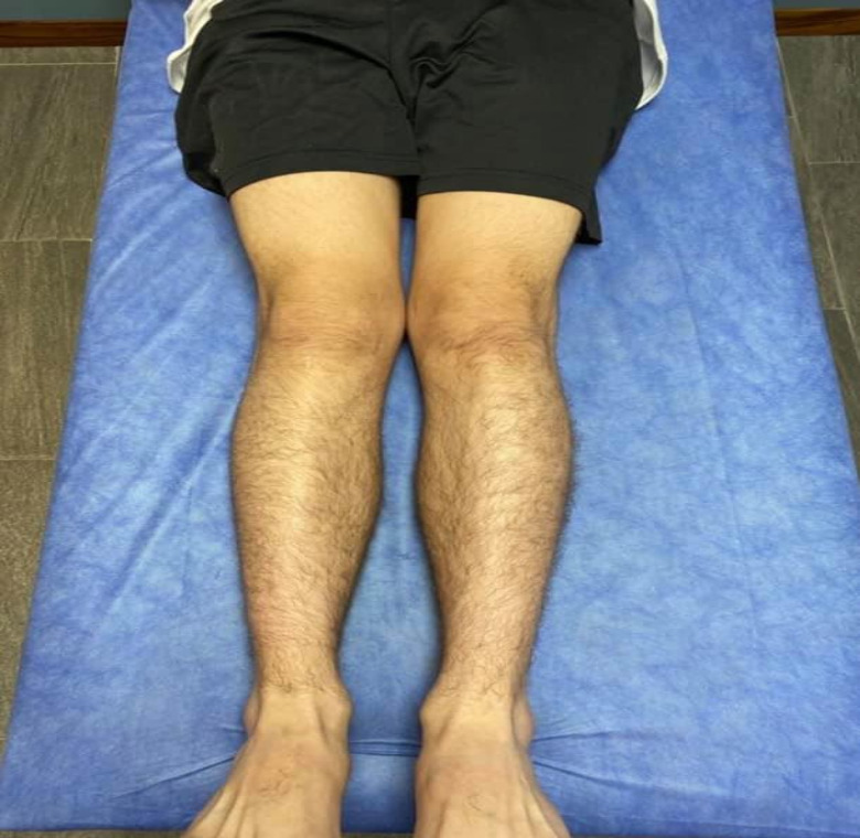 ectrodactilia deformidad en  pie