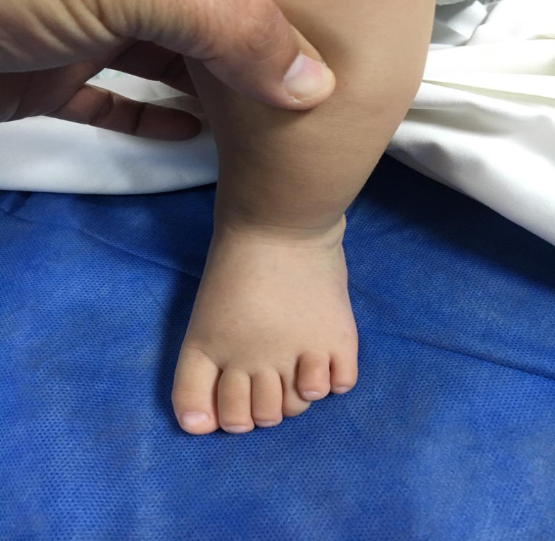 ectrodactilia deformidad en  pie