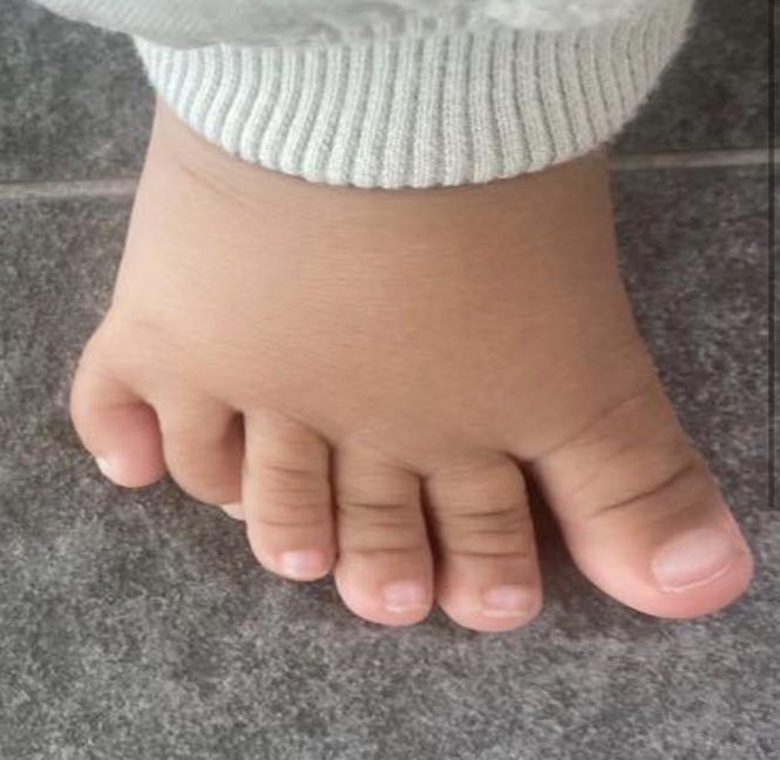 Polidactilia multiple