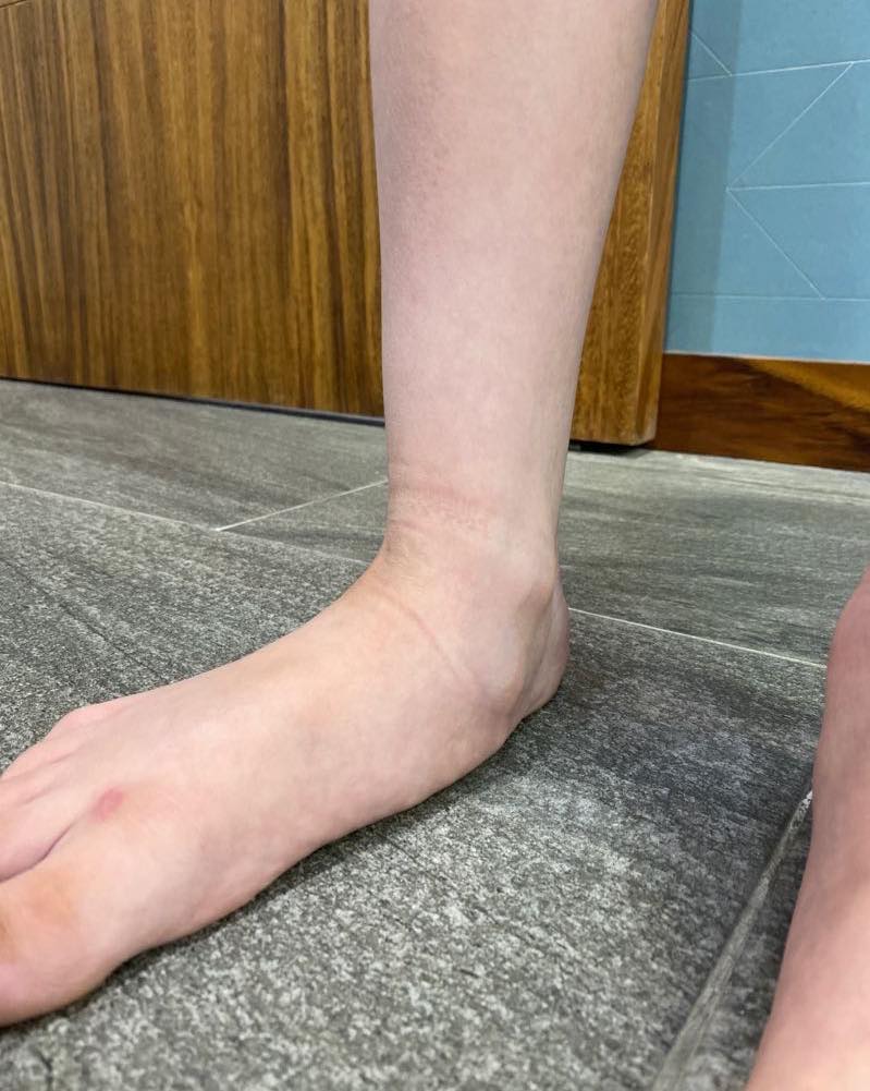 pie plano limitacion 2