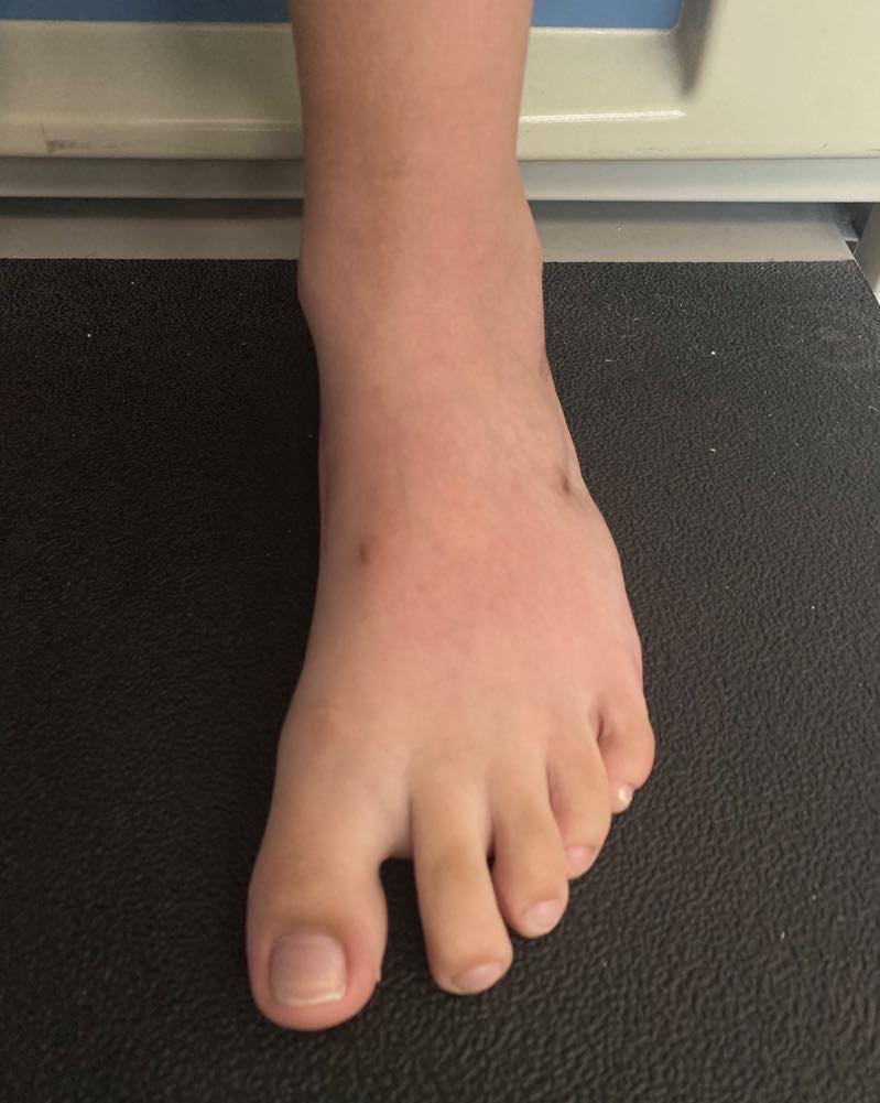 pie plano limitacion 4