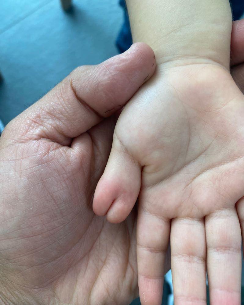 recostruccion de pulgar 2