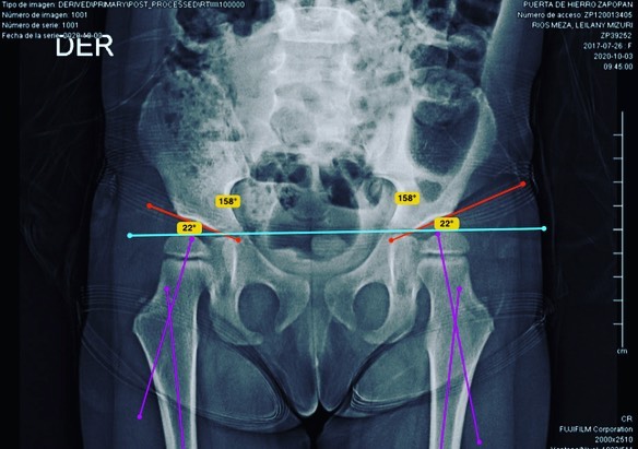 displasia de cadera 2