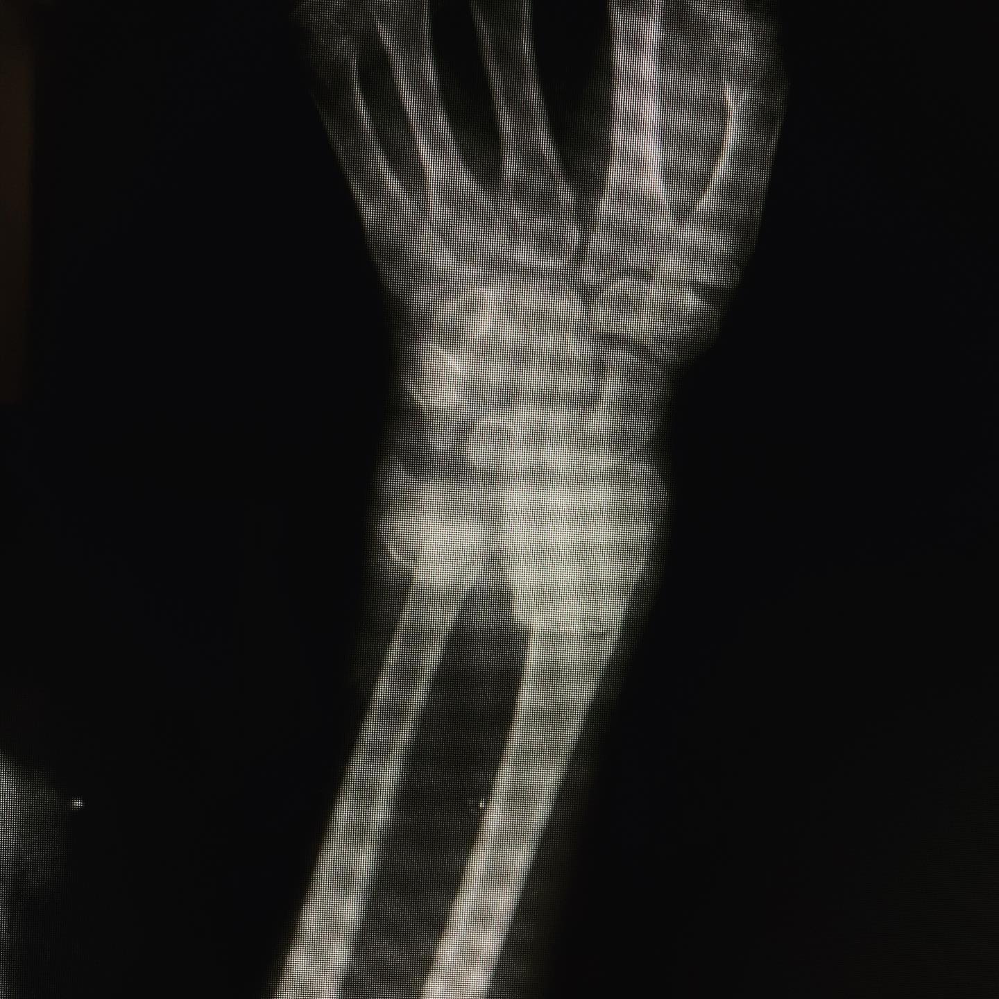 fractura de antebrazo 2