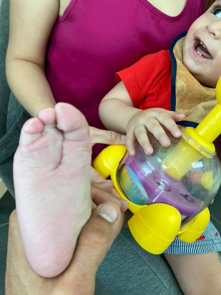 ectrodactilia deformidad en pie 3