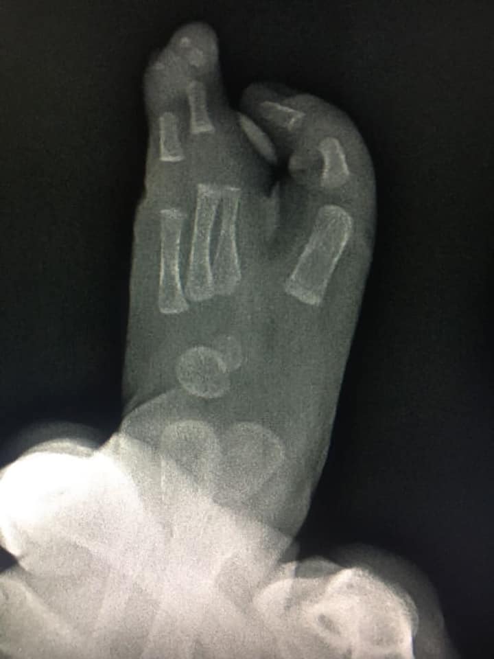 ectrodactilia deformidad en pie 4