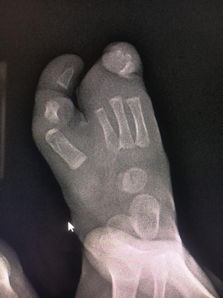 ectrodactilia deformidad en pie 5