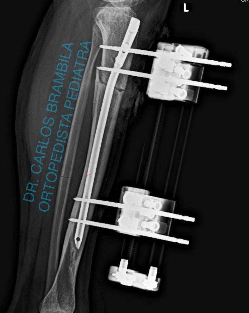fractura de tibia 4