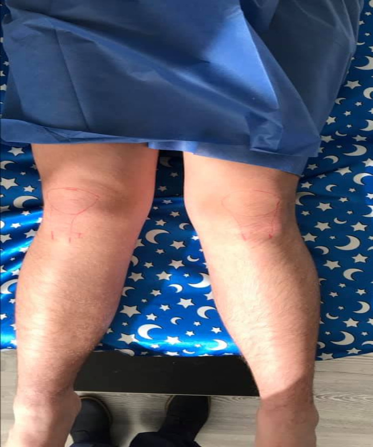 Rodillas en valgo con rótula alta 2