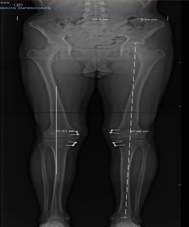Rodillas en valgo con rótula alta 5