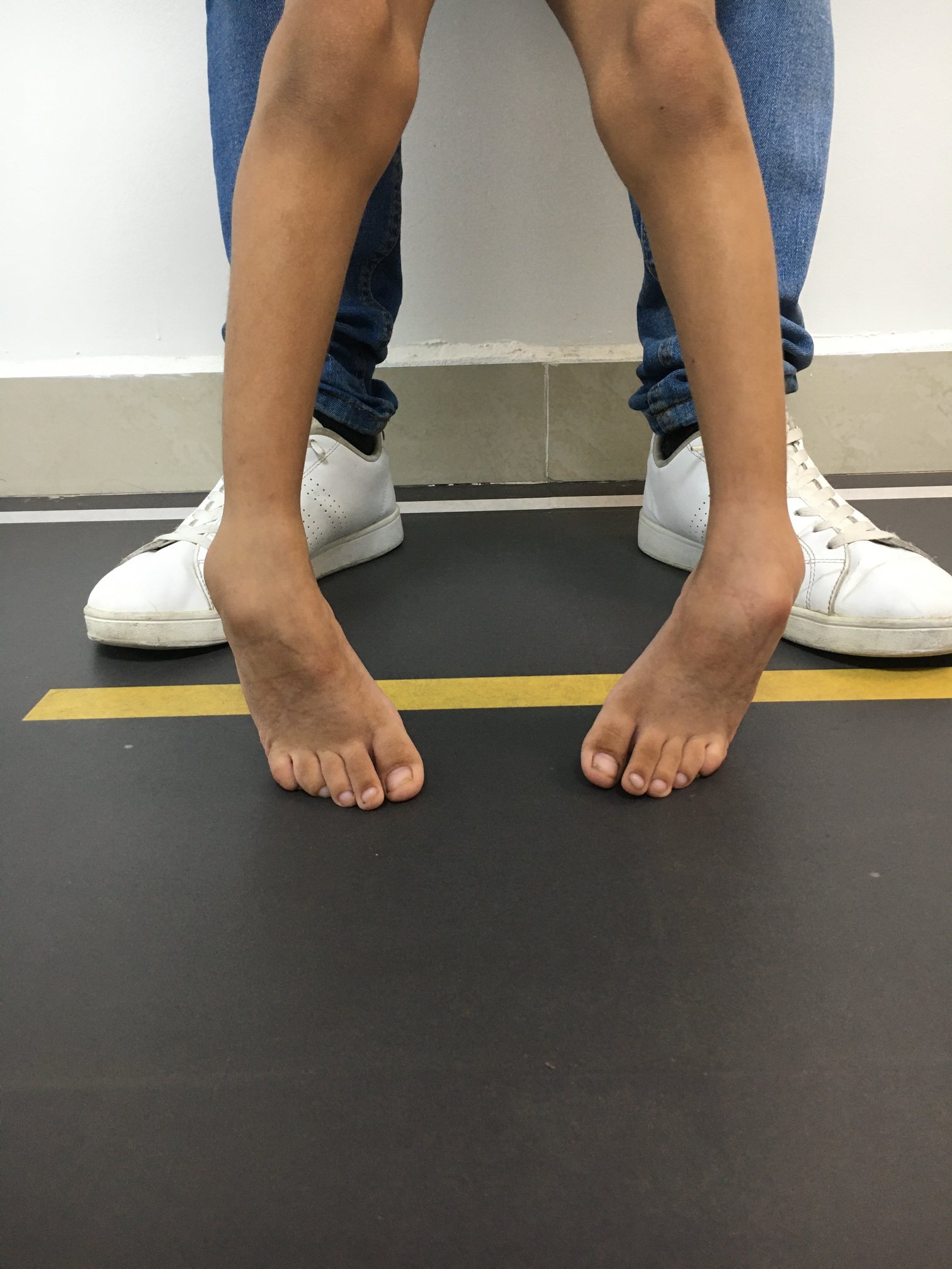 Enfermedad neurológica deformidad en pies 2