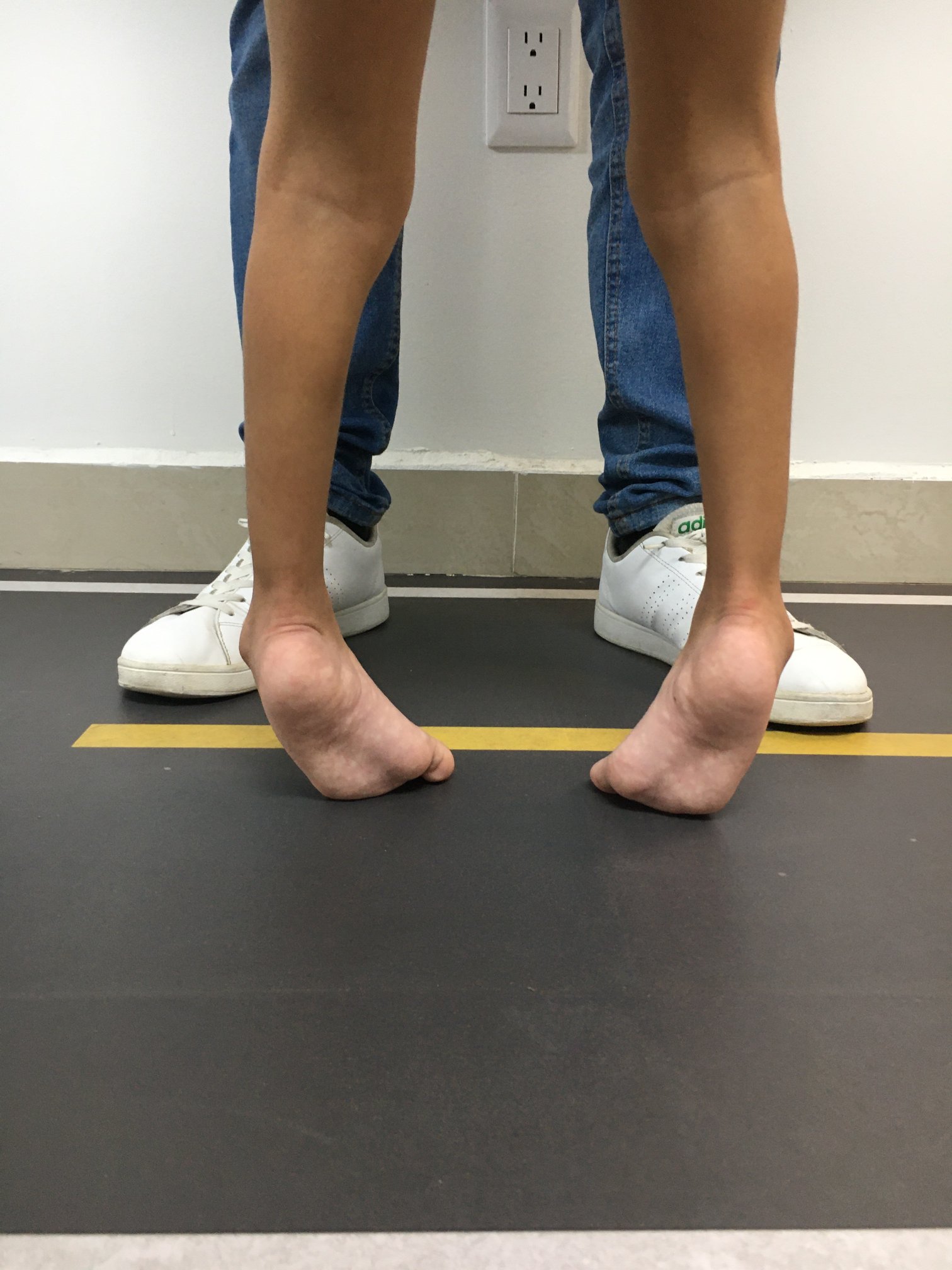 Enfermedad neurológica deformidad en pies 4