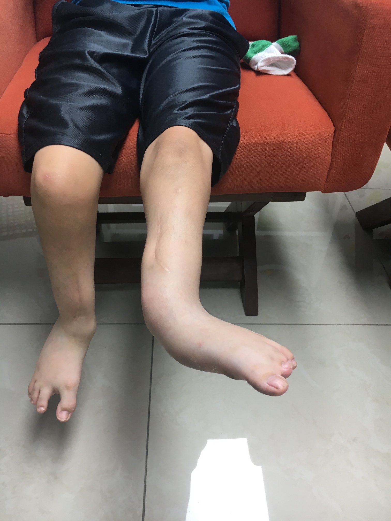 Ausencia congenita del peroné 2