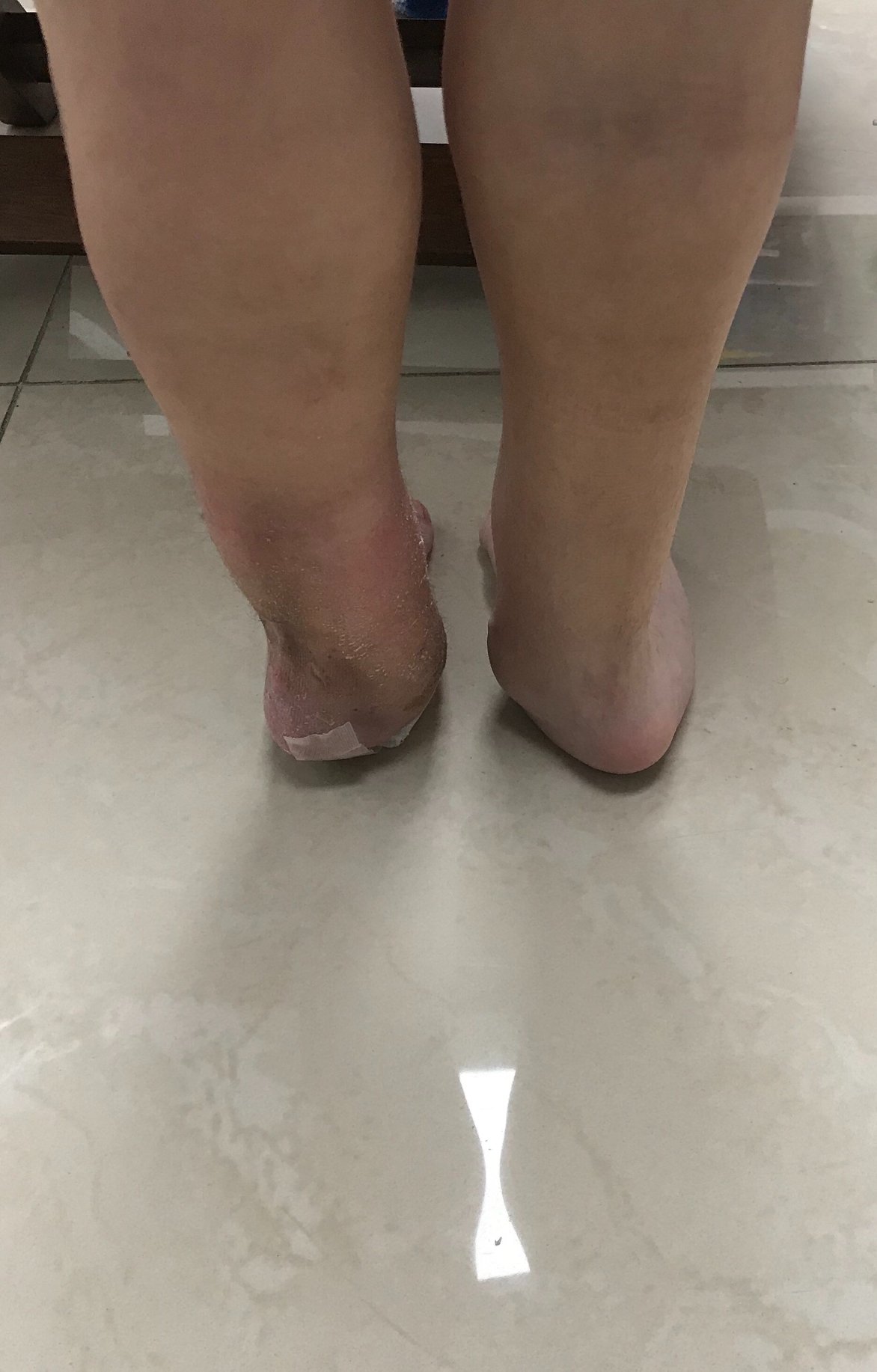 Ausencia congenita del peroné 4