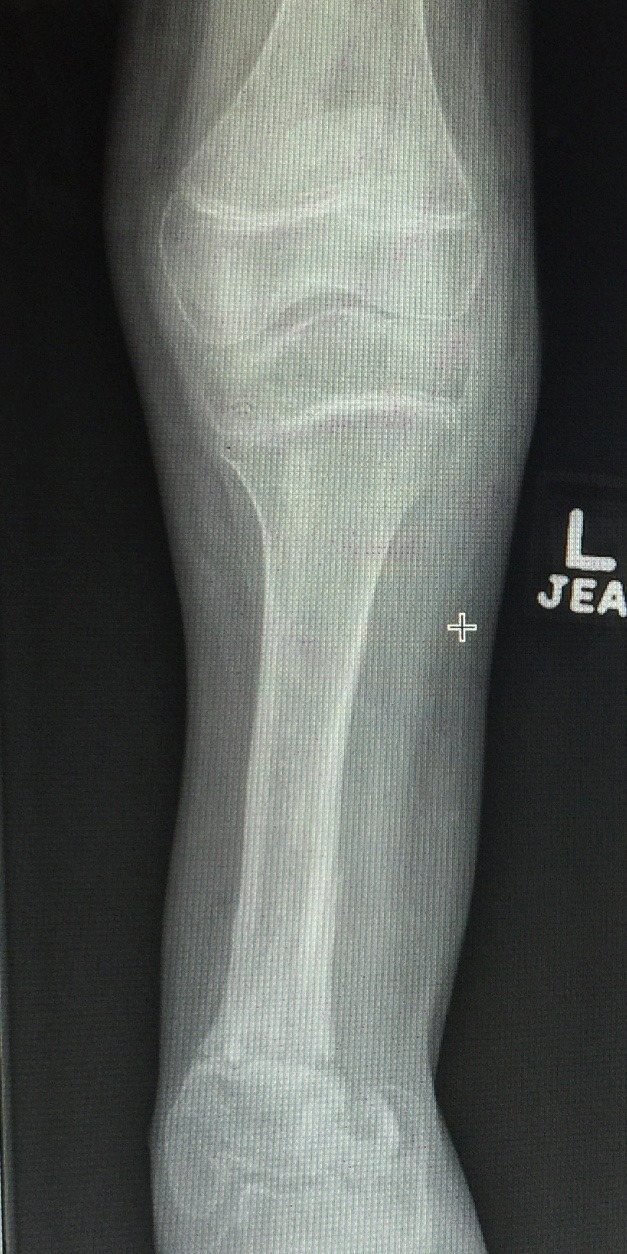 Ausencia congenita del peroné 4