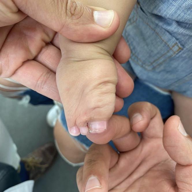 reconstrucción mano 2