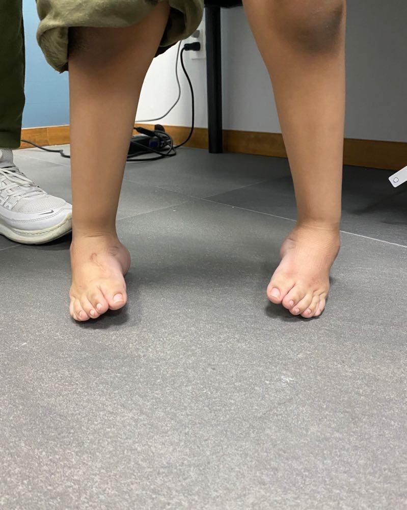 pie equinovaro bilateral 2