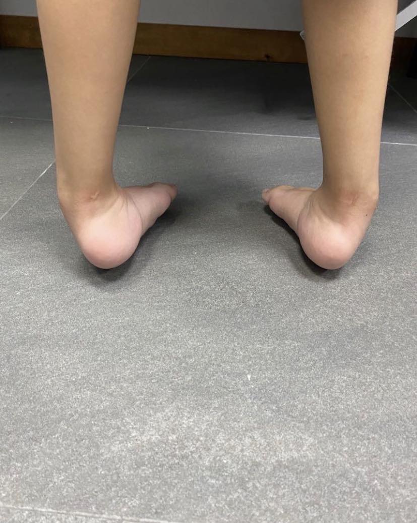 pie equinovaro bilateral 3