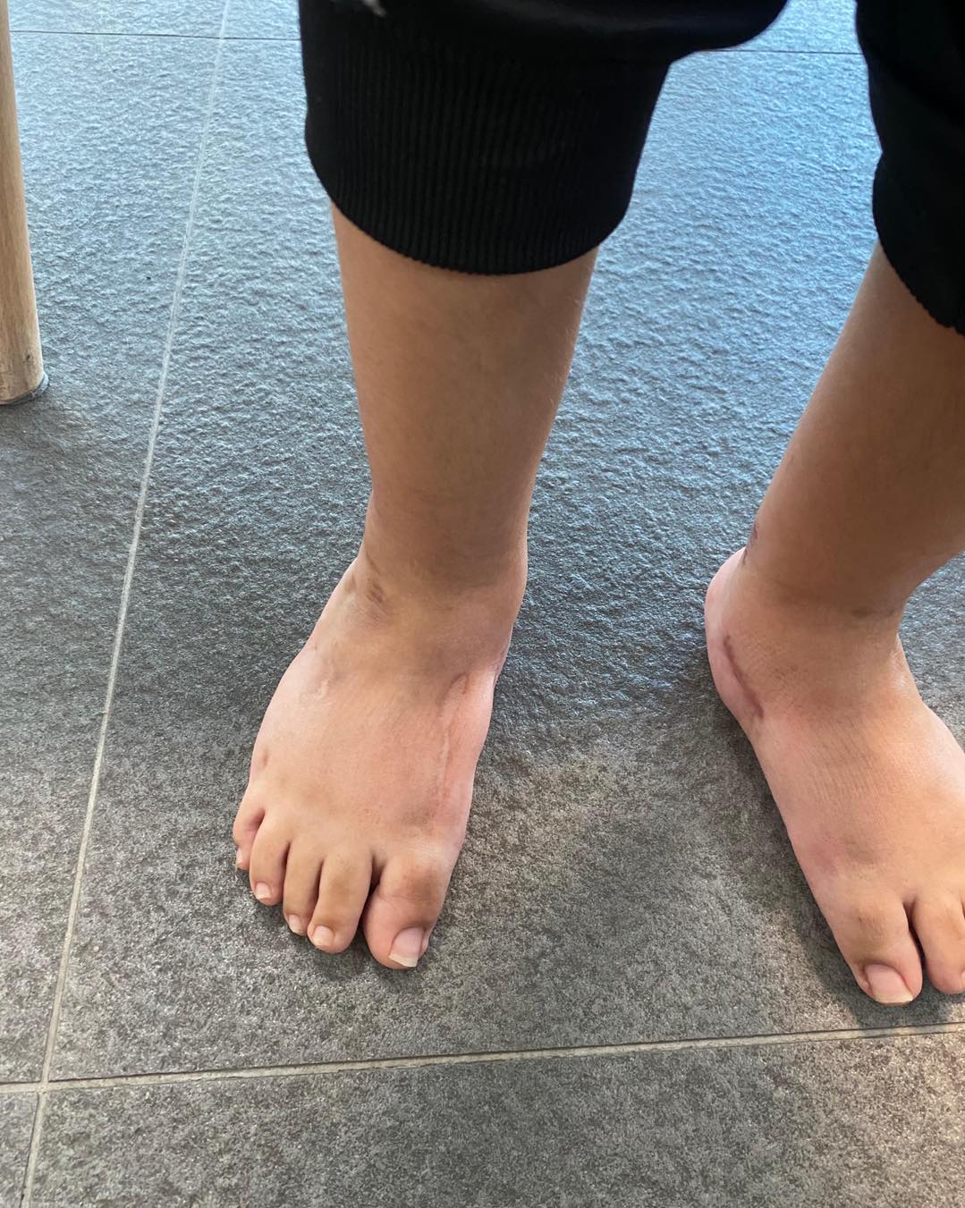 pie equinovaro bilateral 4