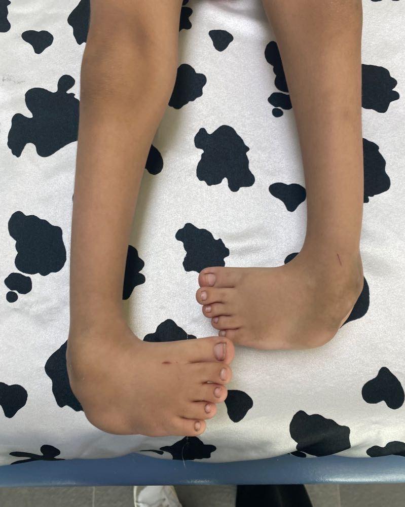 Atrogriposis con cadera luxada 2